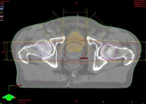 Prostate-plan-example-300×215