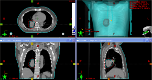 chest-CT-example-300×159